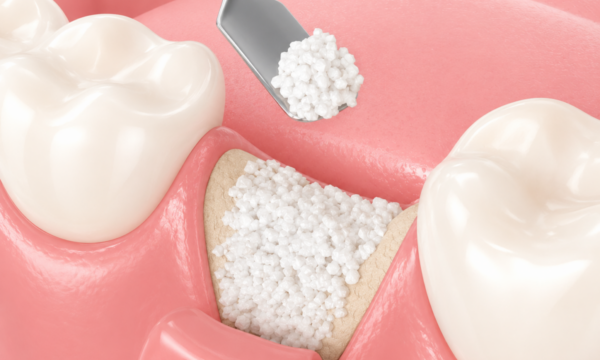치근단 염증이 신경관 근처까지 퍼졌을 때 — 발치와보존술로 임플란트 준비하는 이유 | 강서구 방화동 서울곧은치과